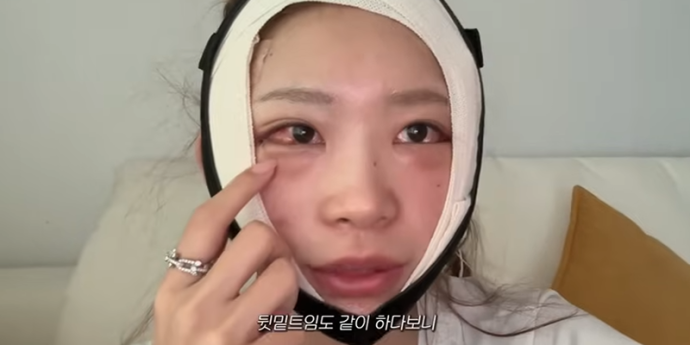 ‘故 최진실 딸’ 최준희, 성형 후기 공개...“앞이 안보여”