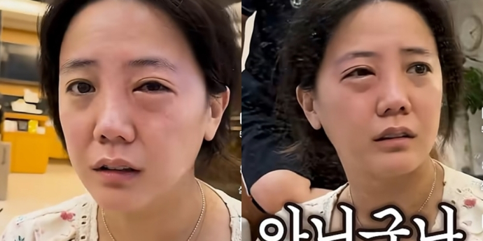고은아, 역대급 알레르기 증상… “촬영 앞두고 비상”